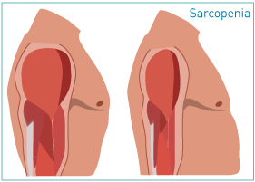 of osteoporosis related to sarcopenia and its components according to